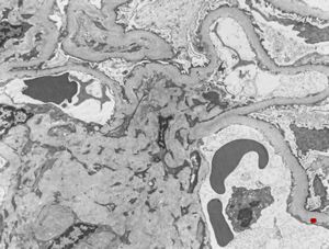 M,65y. | difuse diabetic glomerulosclerosis M,65y. | difuse diabetic glomerulosclerosis